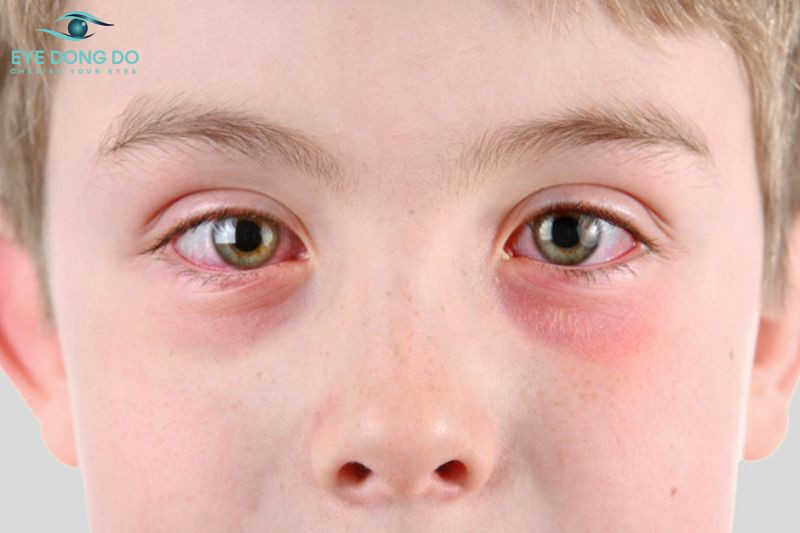 Triệu chứng sưng đỏ, ngứa mắt xuất hiện ở người bệnh giác mạc hình chóp