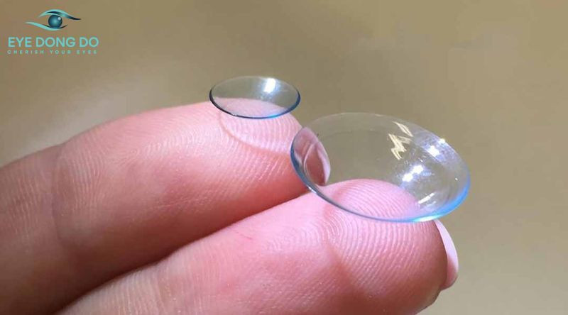 Sử dụng kính áp tròng để điều trị bệnh giác mạc hình chóp