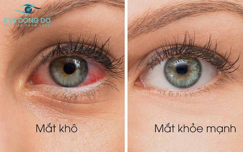 Bệnh nhân nên cẩn trọng với các dấu hiệu khô mắt