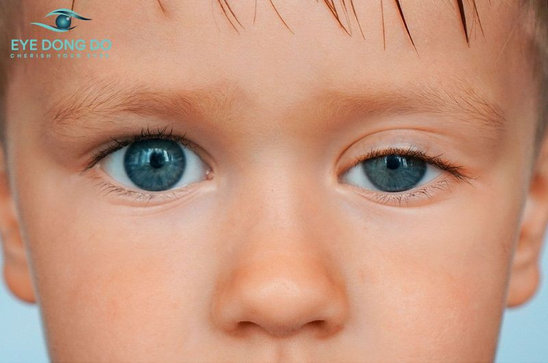 Sụp mí được chia thành ba mức độ chính