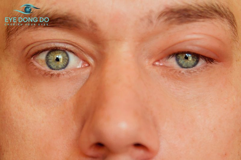 Sụp mí mắt là tình trạng nhiều người gặp phải