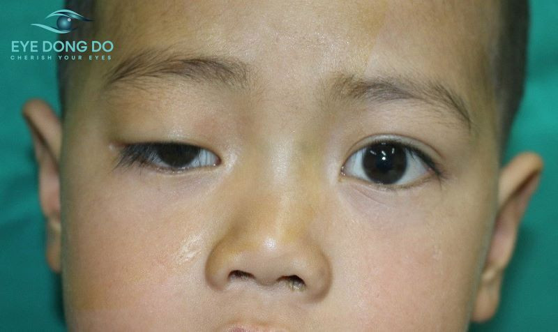 Mắt bị sụp mí do bẩm sinh là ảnh hưởng của tình trạng rối loạn 