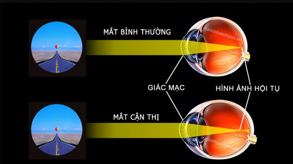 Mắt càng ngày càng cận: Lý do tăng cận nhanh mà ít ai biết