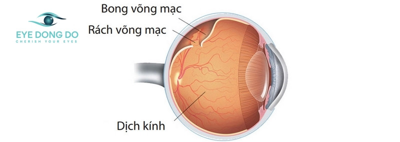 Bong võng mạc khiến cho mắt bị mờ