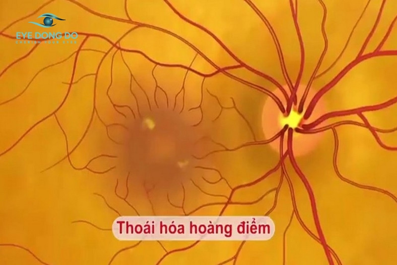 Thoái hóa điểm vàng là một trong những nguyên nhân hàng đầu gây ra mắt mờ