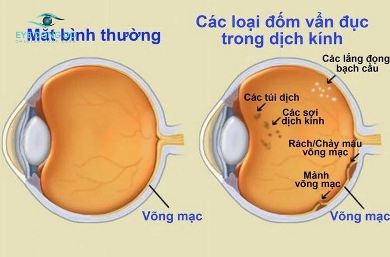 Vẩn đục dịch kính cũng là nguyên nhân khiến cho mắt bị mờ