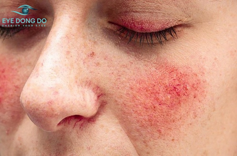 Bệnh đỏ mắt gây ra ngứa, khó chịu cho người bệnh