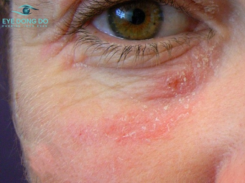 Nguyên nhân viêm da tiếp xúc có thể do người bệnh làm việc trong môi trường bụi bẩn, khói bụi, sơn nước