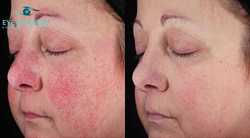 Có rất nhiều nguyên nhân gây ra chứng đỏ mắt