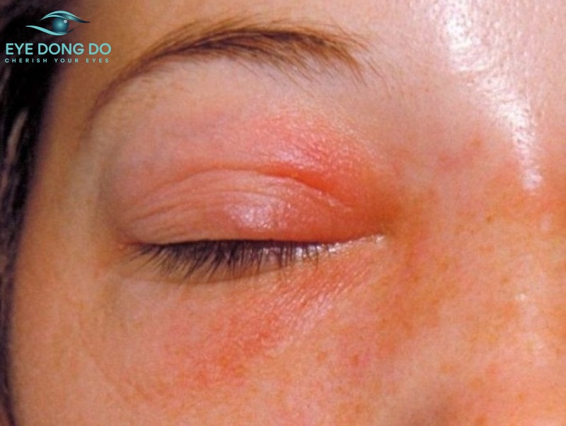 Viêm da dị ứng là nguyên nhân khiến mí mắt bị khô và kích ứng