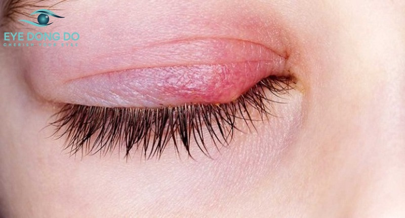 Dấu hiệu dễ nhận biết của viêm bờ mi chính là sưng, đỏ mí mắt