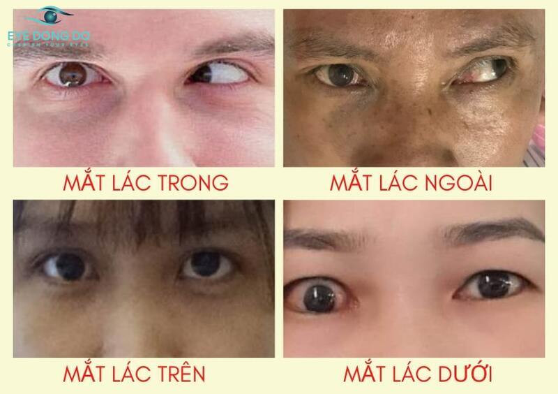 Mắt lác có thể gặp ở nhiều lứa tuổi