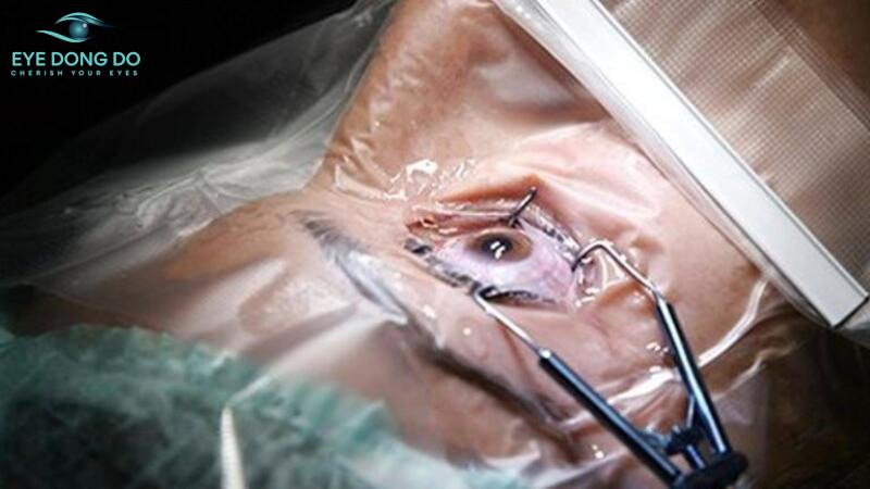 Quá trình mổ mắt lác nhanh chóng 