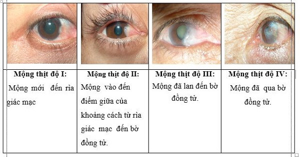 Phân loại mộng mắt theo WHO