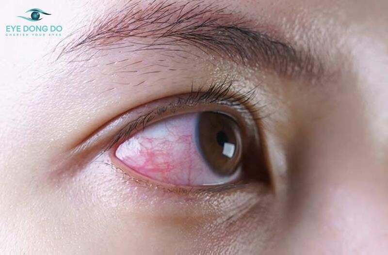 Nhiễm trùng mắt bệnh lý hay gặp và vô cùng nguy hiểm