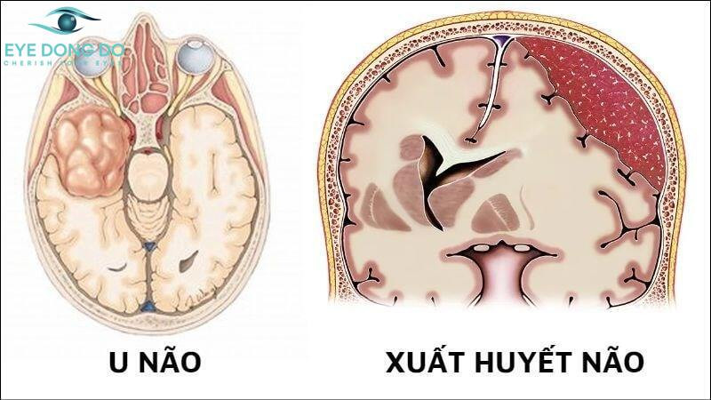 Nguyên nhân phù gai thị do u não và xuất huyết não