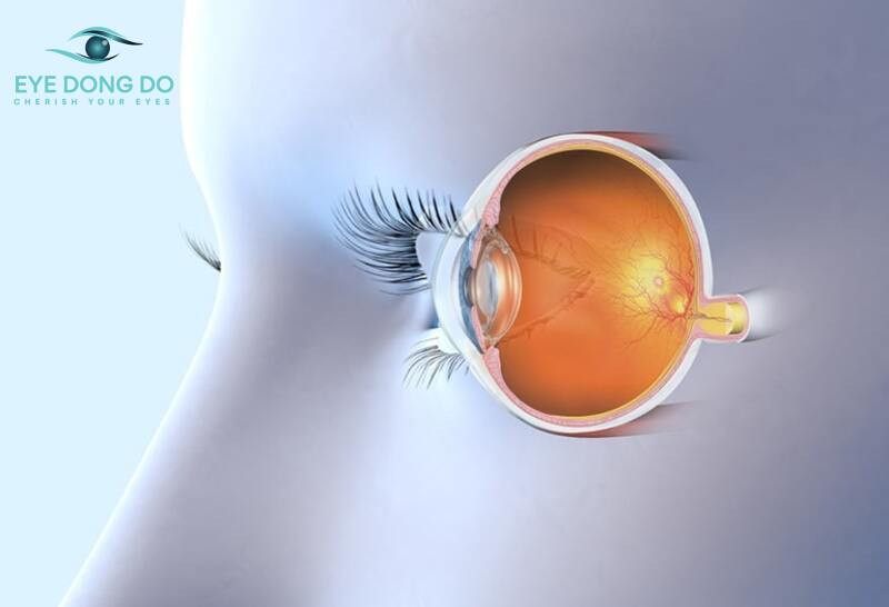 Thiếu máu gây teo dây thần kinh thị giác