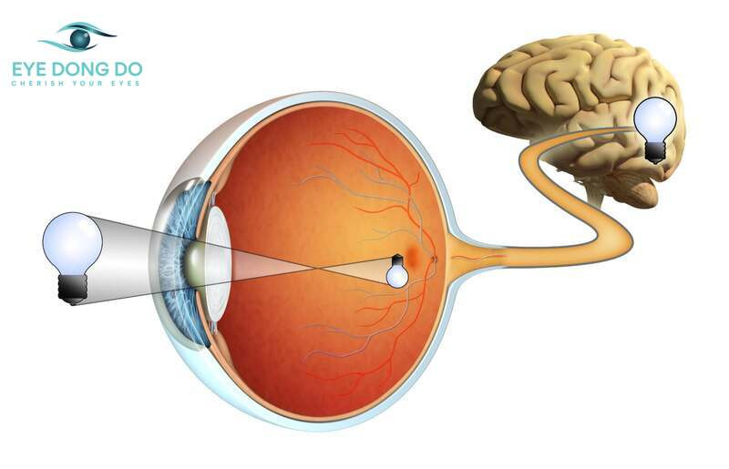 Hình ảnh teo dây thần kinh thị giác