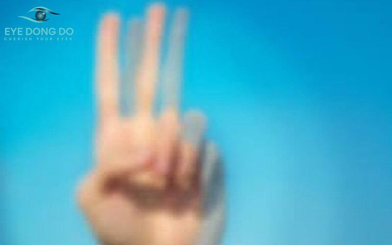 Hình ảnh khi bệnh nhân mắc tật khúc xạ mắt