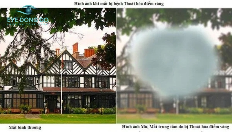 Hình ảnh khi bệnh nhân mắc thoái hóa điểm vàng