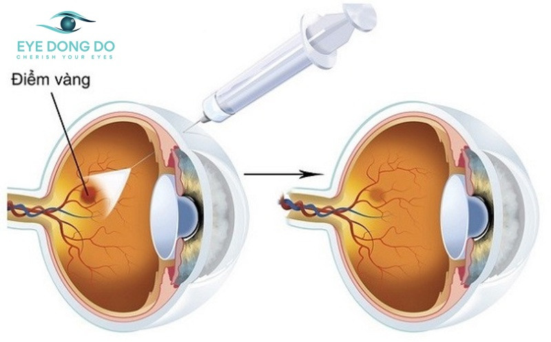 Điều trị thoái hóa điểm vàng