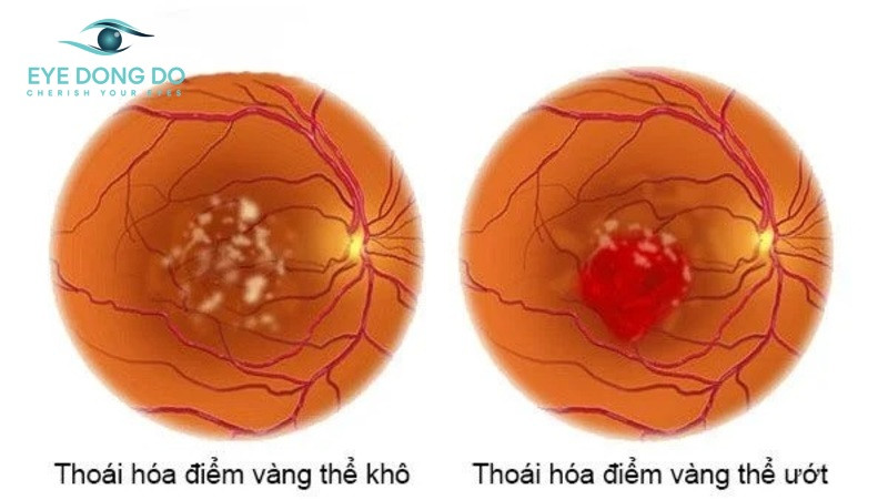 Thoái hóa điểm vàng – Nguyên nhân dẫn đến mù lòa