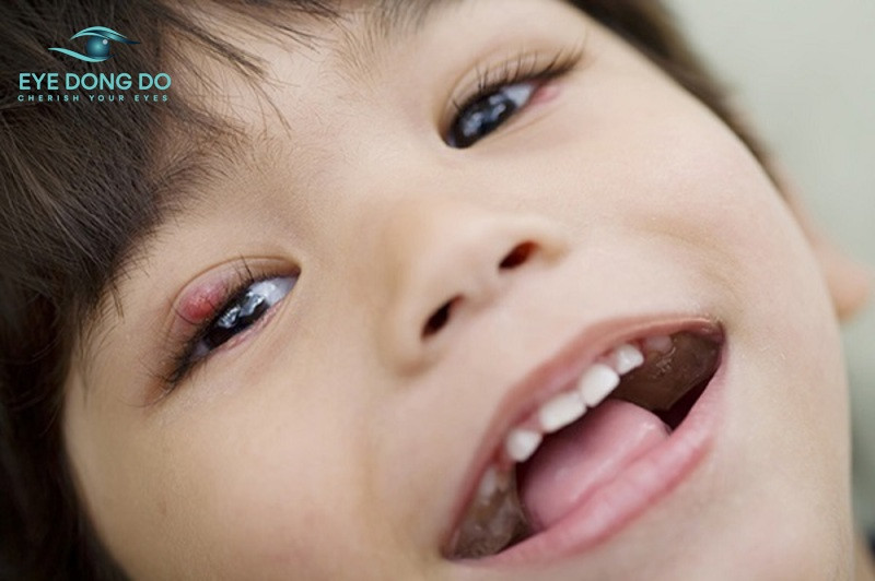 Có nhiều nuyên nhân trẻ bị viêm bờ mi mắt