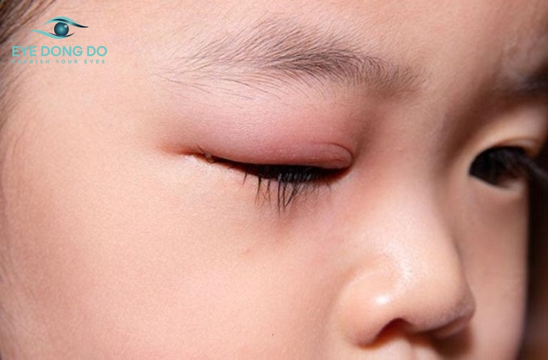 Trẻ bị viêm bờ mi mắt là tình trạng khá phổ biến