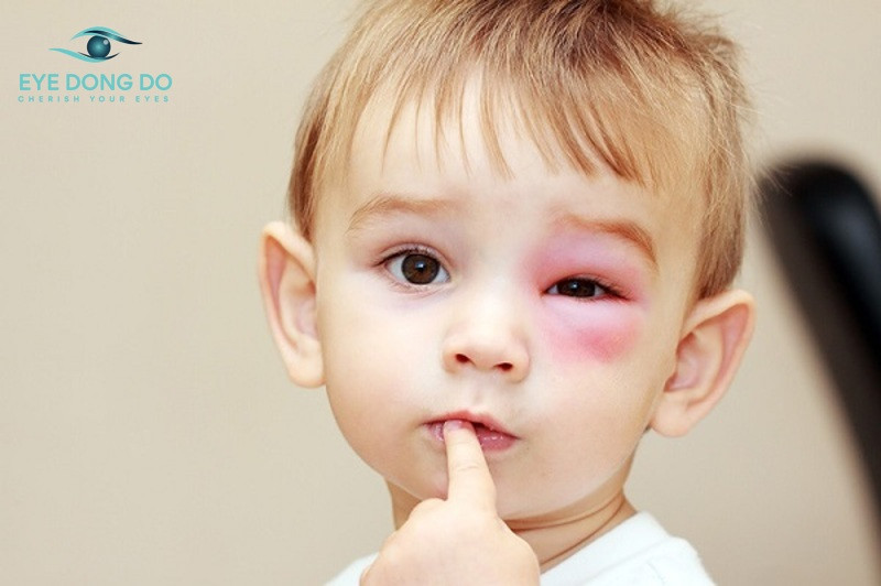 Một số triệu chứng khi trẻ bị viêm bờ mi mắt