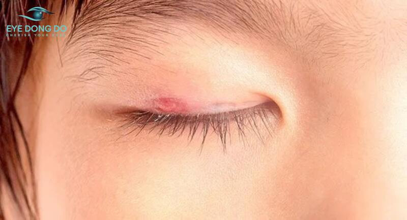 Nguyên nhân gây bệnh ung thư mi mắt vẫn chưa được xác định rõ