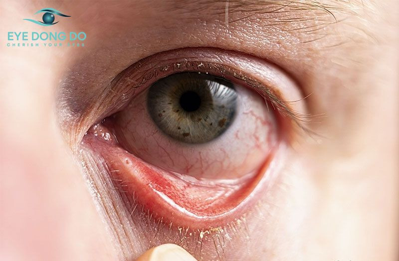 Tỷ lệ người mắc bệnh viêm giác mạc dạng sợi thường rất cao