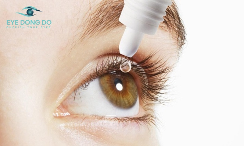 Điều trị viêm mí mắt bằng thuốc nhỏ mắt