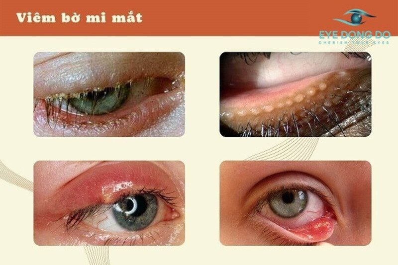 Viêm mí mắt trên và dưới có thể xuất phát từ nhiều nguyên nhân