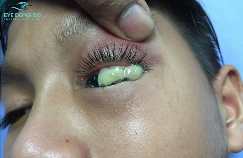 Một trong những biến chứng nguy hiểm của viêm tắc lệ đạo