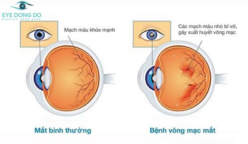 So sánh mắt bình thường và mắt bị võng mạc đái tháo đường