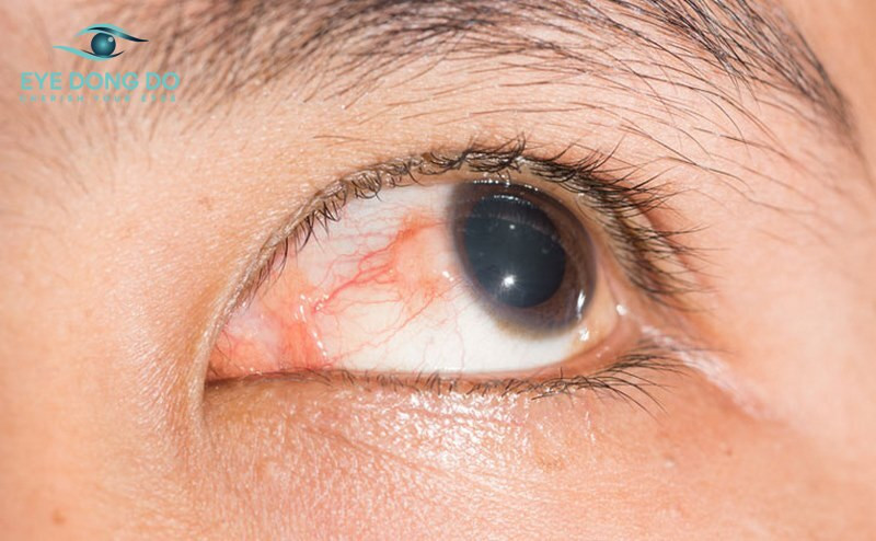 Bệnh nhân bị bệnh tiểu đường có nguy cơ bị xuất huyết giác mạc cao nhất