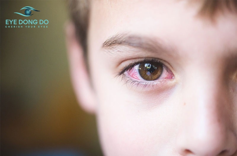 Theo dõi mắt bé thường xuyên để kịp thìw phát hiện xuất huyết võng mạc ở bé