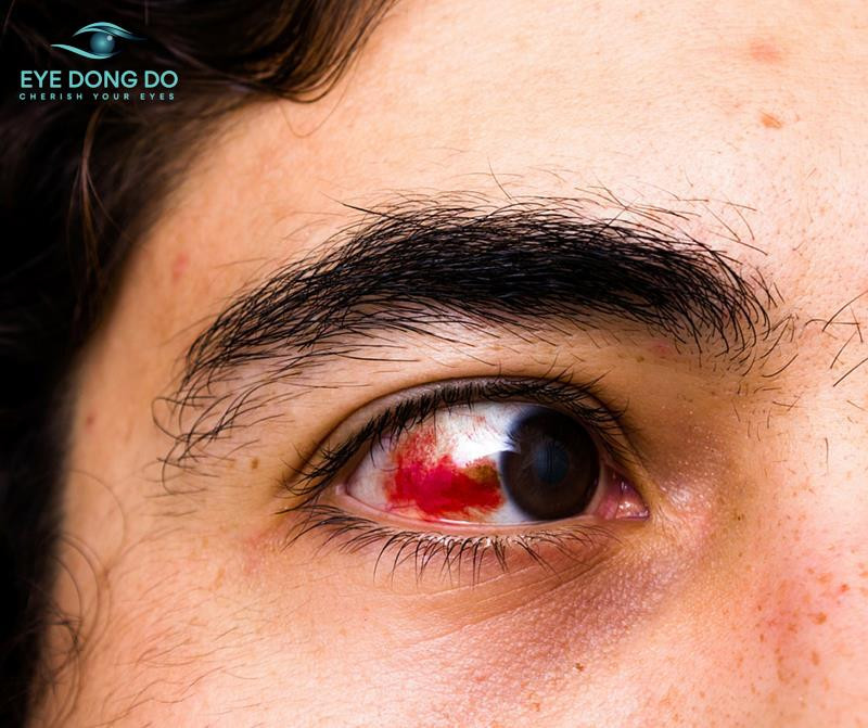 Người bệnh xuất huyết võng mạc cảm thấy màu đỏ trong tầm nhìn