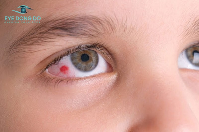 Soi đáy mắt là phương pháp chẩn đoán xuất huyết võng mạc chính xác