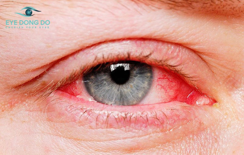 Bổ sung vitamin A, B, C và E là một phương pháp giúp điều trị xuất huyết võng mạc